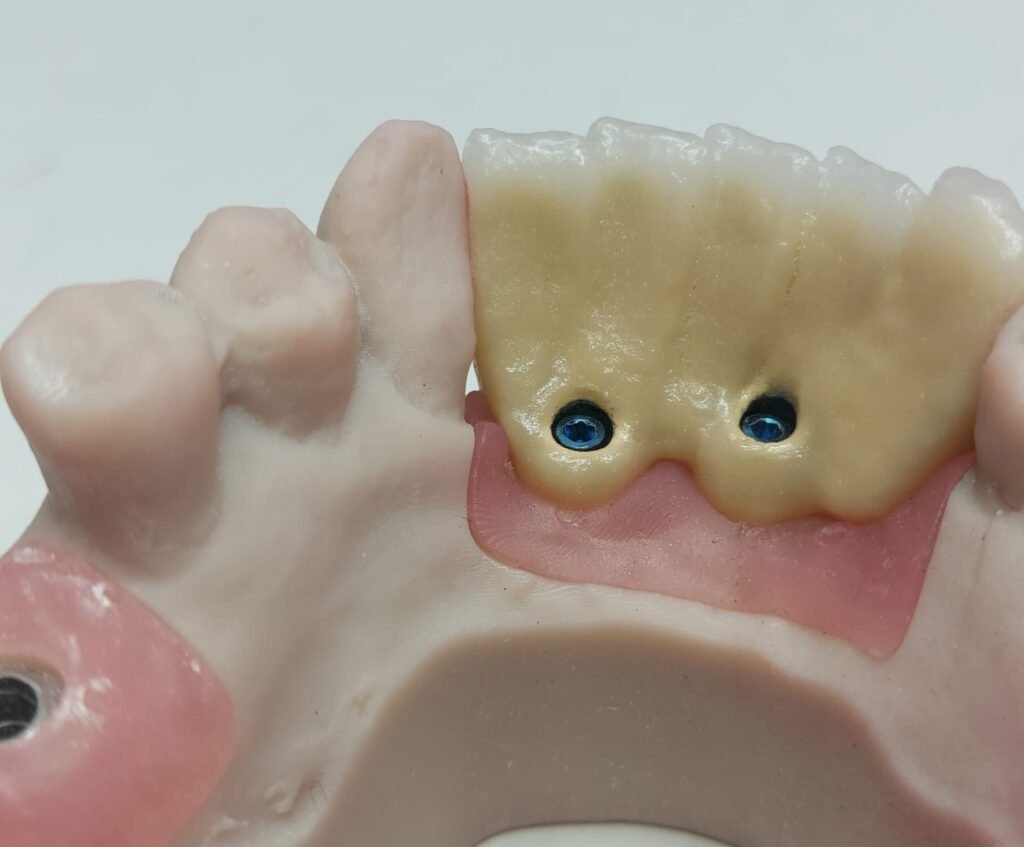 Prótesis dental