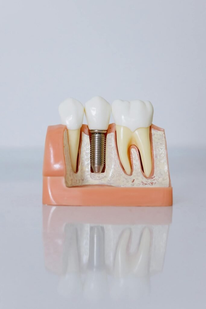 Implantes